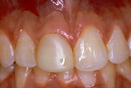 Crowns case 1, before: discolored, uneven upper front teeth