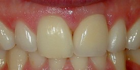 Crowns case 2, after: the gap filled and the front teeth restored