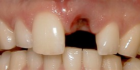 Crowns case 2, before: a missing upper front tooth leaves a gap