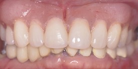 After treatment: close-up of the restored upper and lower teeth