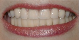 After treatment: the restored smile framed by the lips
