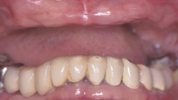 Before treatment: close-up with the upper teeth missing