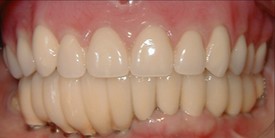 Before treatment: close-up of the upper and lower teeth