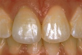 Crowns case 1, after: the upper front teeth restored with crowns