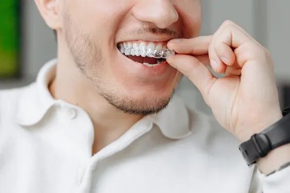 Man fitting a clear aligner over his teeth